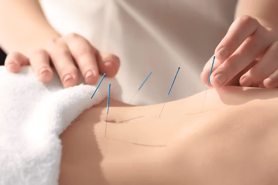 Does acupuncture help with&nbsp;fertility?